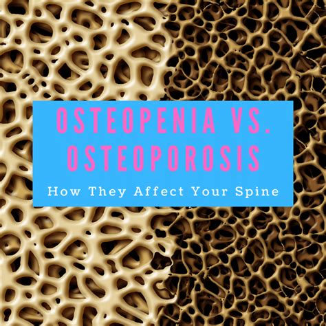 Ostopenia Vs. Osteoporosis: How They Affect Your Spine | New Jersey ...