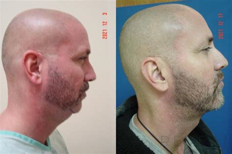 Chin Augmentation Before and After Photo Gallery | San Jose, CA ...