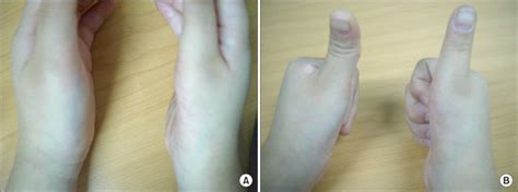 (A) Thenar eminence of the right hand showed severe atrophy compared ...