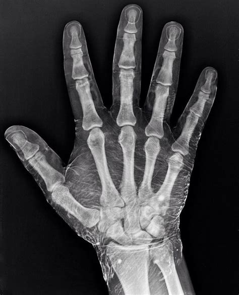 X-ray of a hand dipped in iodine. Iodine absorbs X-rays, revealing the ...