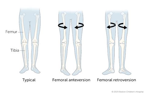 Femoral Anteversion Angle