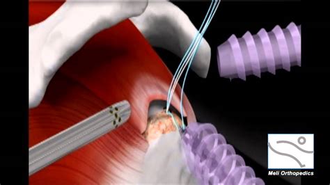 Arthroscopic Rotator Cuff Surgery from Meli Orthopedic Centers of ...