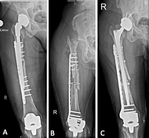 X-rays of case 2. a Periprosthetic infection after the treatment of a ...