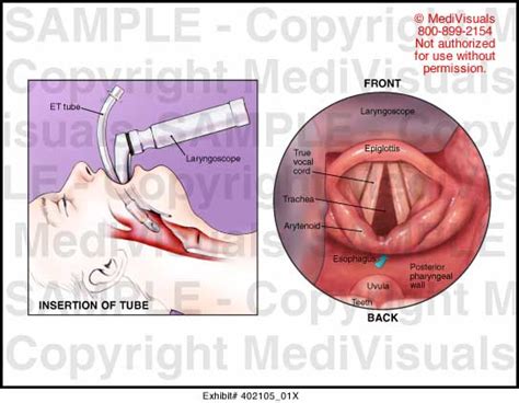 Endotracheal Intubation Vocal Cords