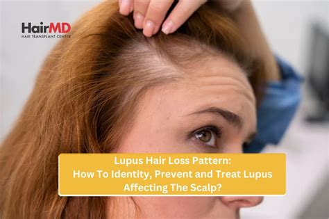 Identify Lupus Affecting Hair Scalp : Prevent and Treatment