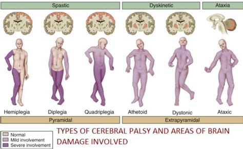 Signs & Symptoms - Cerebral Palsy