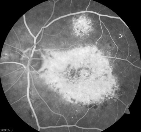 Choroidal hemangioma – the retina vault