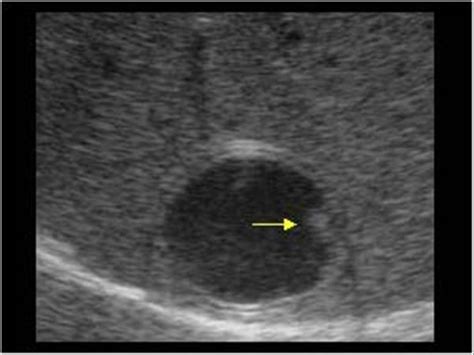 Abdomen and retroperitoneum | 1.1 Liver : Case 1.1.5 Hydatid cysts ...