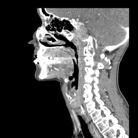 Clival masses | Radiology Reference Article | Radiopaedia.org