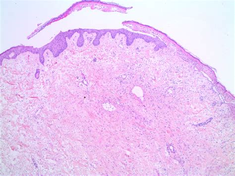 Fibroepithelial Polyp Histology