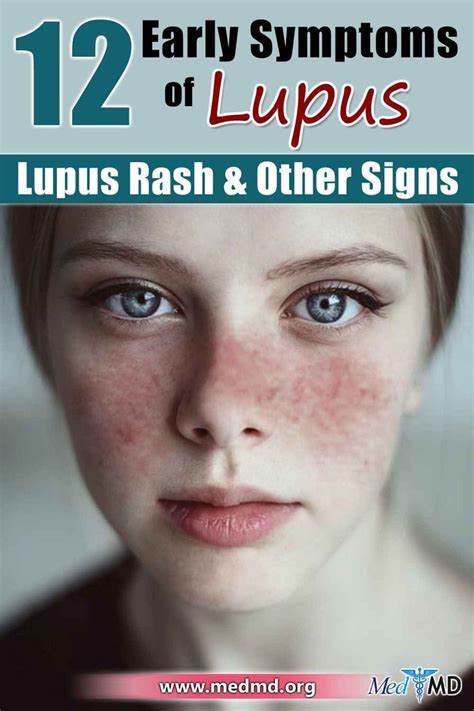 12 Early Symptoms of Lupus - Lupus Rash & Other Signs | Lupus rash ...