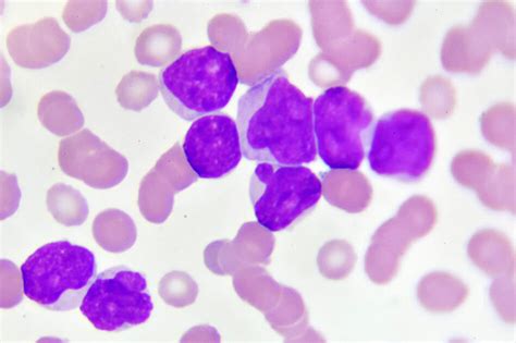 Hematologic Malignancies, Myeloid | SeraCare