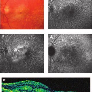 (PDF) Photodynamic therapy for choroidal neovascularisation secondary ...