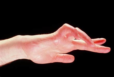 Claw-hand Due To Trapped Ulnar Nerve Photograph by Science Photo ...