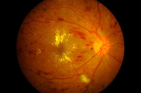 ¿Qué es un edema macular? Causas, Síntomas y Tratamiento