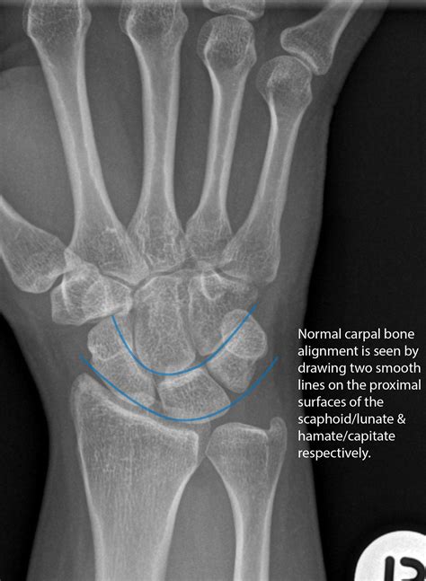 Carpal Bone X Ray Normal