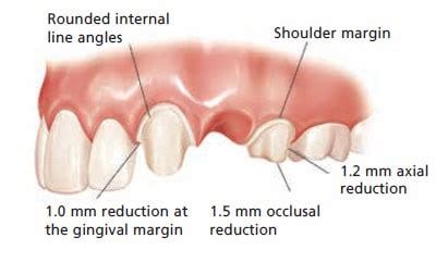 All Ceramic Crown Anterior