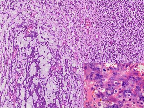 Note the nuclear pleomorphism, more often seen in MEC (Case 3 ...