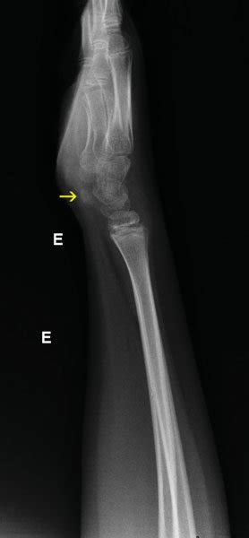 Lateral radiography view of the left wrist showing the anterior ...