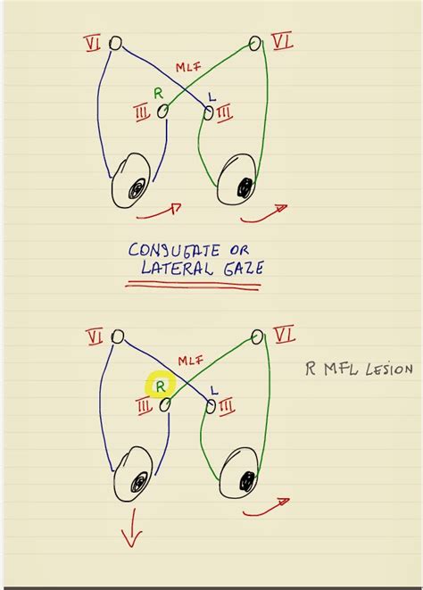 Quike & Vivi's World: Conjugate or Lateral Gaze