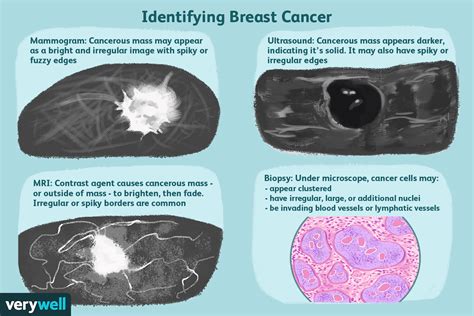 What Does Breast Cancer Look Like On An Ultrasound