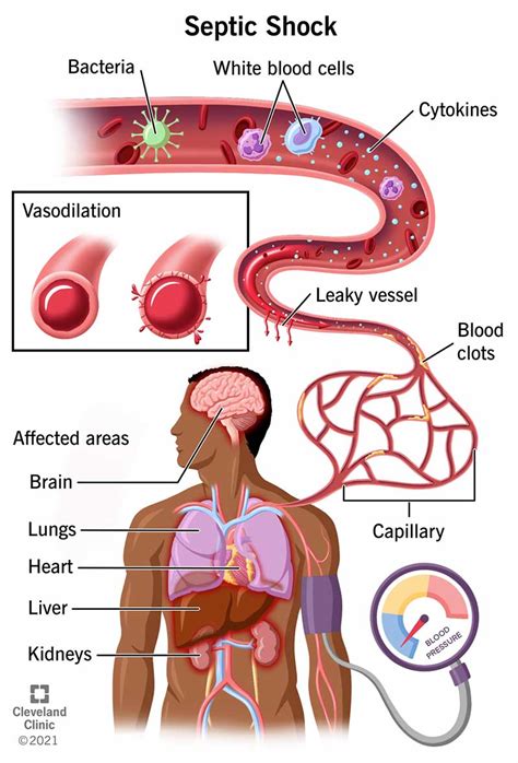 Septic Shock: Causes, Symptoms & Treatment