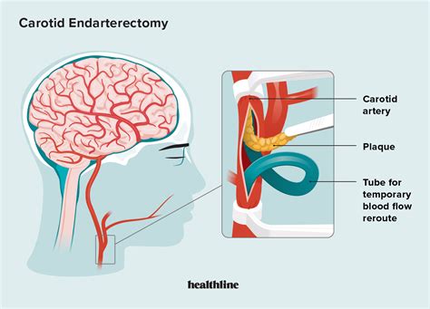 Carotid Endarterectomy FAQs: Procedure, Uses, Recovery, Risks