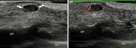 Ganglion Cyst Foot Ultrasound