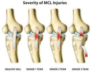 Common Questions About MCL Knee Sprains | Beacon Orthopaedics & Sports ...