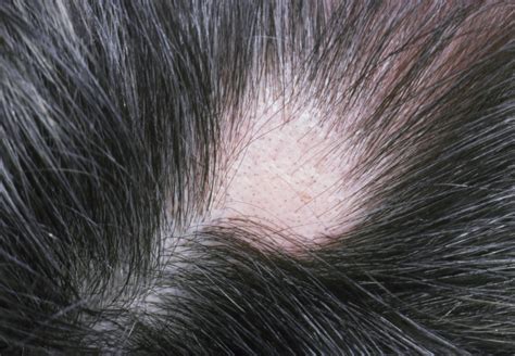 Cyclosporin Possibly Effective to Induce Hair Regrowth in Alopecia ...