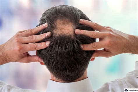 Bald spot on crown: how to spot it, how to stop it? | HairPalace