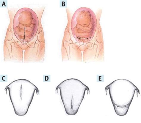 Figure 1 from The History of the Low Transverse Cesarean Section: The ...