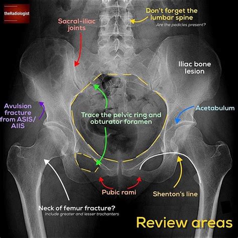 👨🏽‍💻Want to learn a system for reviewing a pelvic X-ray? Read on to ...