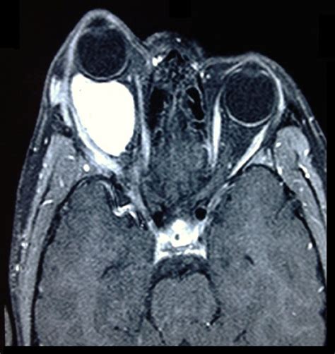 Capillary Hemangioma: MRI of the brain with orbital protocol showed a ...