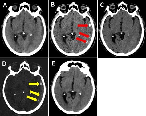 Utilizing dual energy CT to distinguish blood from contrast leakage ...