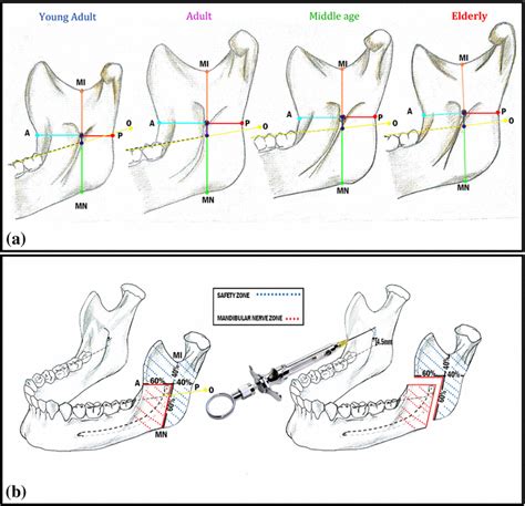 a Location of the MF in relation to the mandibular landmarks used in ...