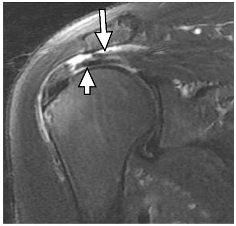 Diagnostics | Free Full-Text | Delaminated Tears of the Rotator Cuff ...