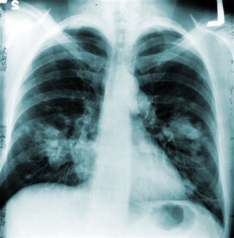 Chest X-ray Nodules Lung cancer chest ray rays deaths nih annual cut