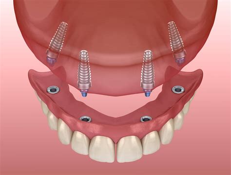 Kinds of Implant-Supported Tooth Replacement Solutions - Village Square ...