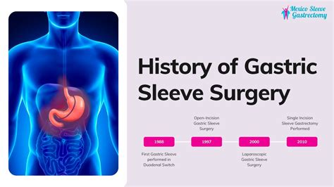 The History of Gastric Sleeve Surgery (Vertical Sleeve Gastrectomy ...