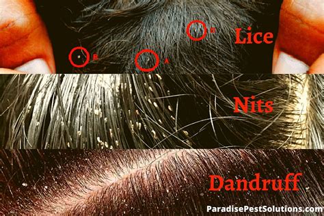 Lice vs Dandruff: How To Tell The Difference?