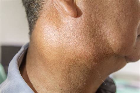 7 Symptoms of Salivary Gland Cancer - Facty Health