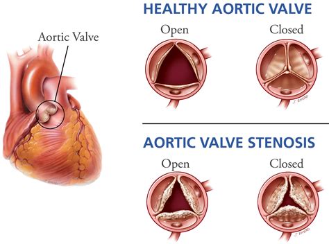 Aortic Valve Stenosis - Causes, Symptoms, Life Expectancy, Treatment