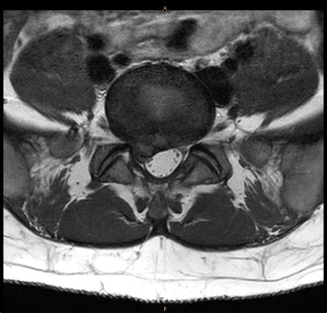 Large L5/ S1 Disc Protrusion Case for Treatment & Management