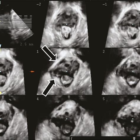 Types of episiotomy [110]. Key: a midline episiotomy; b modified median ...