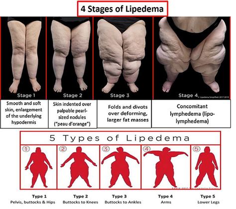 Home | Oregon Lipedema/Dercum Disease Support Group