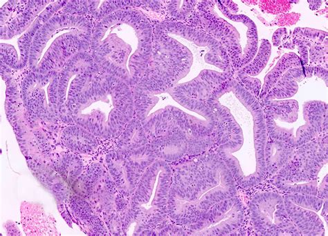 Pathology Outlines - Endometrial hyperplasia