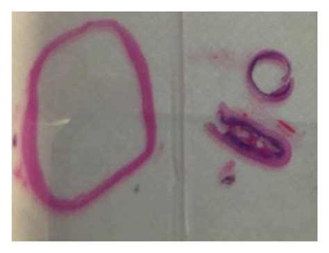 Histology of duplication cyst (stained with haemotoxylin and eosin ...