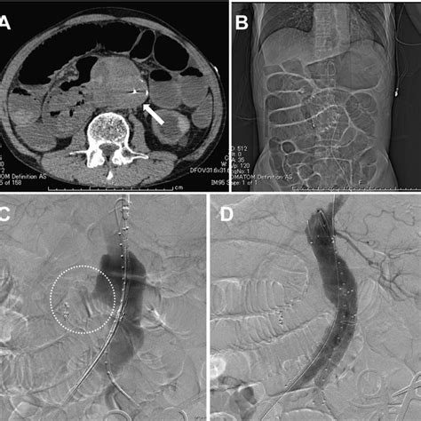 (PDF) Emergency Endovascular Aneurysm Repair Coupled with Staged ...