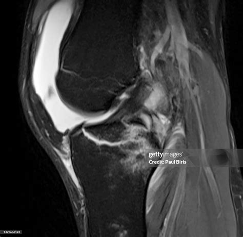 Anterior Cruciate Ligament Avulsion Fracture Or Tibial Eminence ...